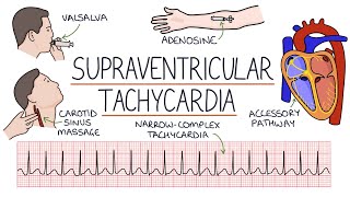 Understanding Supraventricular Tachycardia SVT [upl. by Atlas]