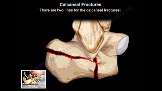 Fractures Causes Signs and Symptoms Diagnosis and Treatment [upl. by Yrakcaz]