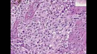 Histopathology Skin Malignant melanom [upl. by Gereld]