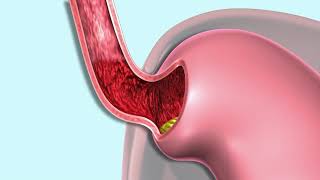 Eosinophilic Esophagitis [upl. by Blayne]