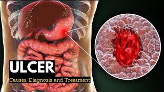 HOW to CURE GASTRITIS without medications  DR CARLOS [upl. by Minna]