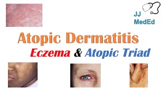 Eczema Atopic Dermatitis  Atopic Triad Triggers Who gets it Why does it happen amp Treatment [upl. by Einnek]