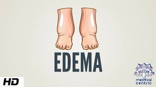 Edema Causes Signs and Symptoms Diagnosis and Treatment [upl. by Anile]