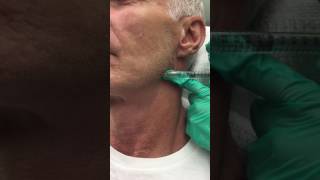 Juvederm Voluma Filler for the Jawline [upl. by Eletnahs440]