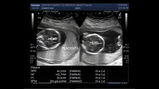 Placenta Previa with a gestational age of the fetus about 19 weeks and three days [upl. by Simmonds]