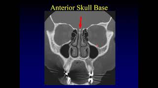 Imaging of the Paranasal Sinuses 1 [upl. by Rutter924]