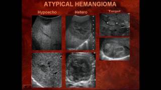 Sonography of Liver Masses [upl. by Esirec]