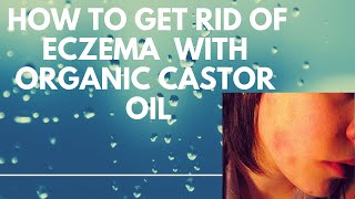 How To Get Rid OF Eczema Naturally With CASTOR OIL [upl. by Imefulo]