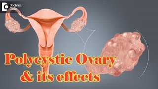 Polycystic ovaries and How does it trouble  Dr Usha B R [upl. by Aicirtal589]