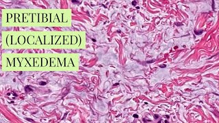 Pretibial localized myxedema explained by a dermatopathologist unknown 12 dermpathiseasy [upl. by Ennayt]