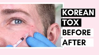 Korean Botulinum Toxin Before amp After  How To Dilute Toxins And Use For Forehead And Crow’s Feet [upl. by Yemrej]