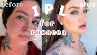 How I treat my ROSACEA  IPL Photofacial 👼🏼 THE FACIAL THAT CHANGED MY FACE [upl. by Wicks21]