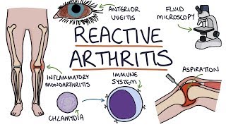 Understanding Reactive Arthritis [upl. by Macdermot]