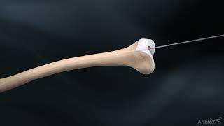 Femoral Nail System Overview [upl. by Still]