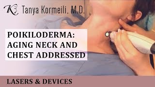 Poikiloderma Aging Neck and Chest addressed [upl. by Ynahteb]