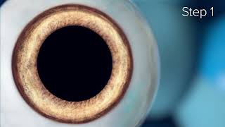 How does the ICL Implantable contact lens procedure work [upl. by Anestassia]