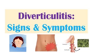 Diverticulitis Signs amp Symptoms And Why They Occur [upl. by Enilatan]