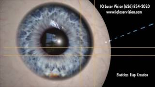 LASIK Eye Surgery for Astigmatism with LasikPlus [upl. by Hsan]