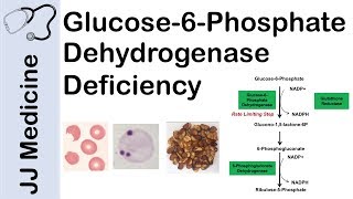 Glucose6Phosphate Dehydrogenase Deficiency  Symptoms Pathophysiology Diagnosis and Treatment [upl. by Parsaye]