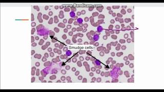 Chronic Lymphocytic Leukemia CLL [upl. by Barnie]