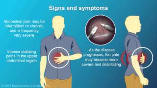 Chronic Pancreatitis [upl. by Range]