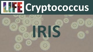 Cryptococcal IRIS [upl. by Haerr557]