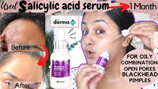 What happened after Using 2 SALICYLIC ACID for 1 Month on OILYCOMBINATION SKIN How amp when to use [upl. by Noiram]