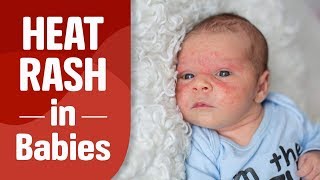 Heat Rash in Babies [upl. by Mayeda]