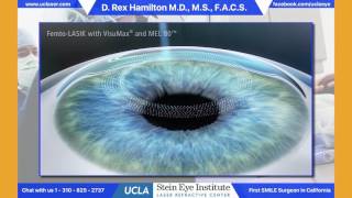 YAG Laser Eye Treatment with Dr Michael Richie [upl. by Bowes817]