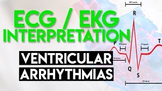 Ventricular Arrhythmias  ECG EKG Interpretation Part 5 [upl. by Pals]